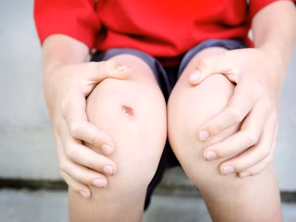 Các vết thương trên da lâu lành cũng được coi là một dấu hiệu sớm cảnh báo bệnh ung thư của cơ thể. Tuy nhiên dấu hiệu này cũng thường bị bỏ qua.