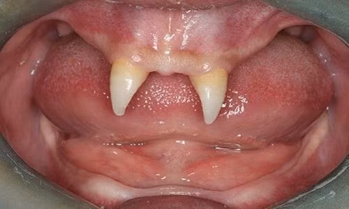Một cậu bé người Trung Quốc mọc duy nhất 2 chiếc răng năng nhọn hoắt giống hệt ma cà rồng. Ảnh; Sina.