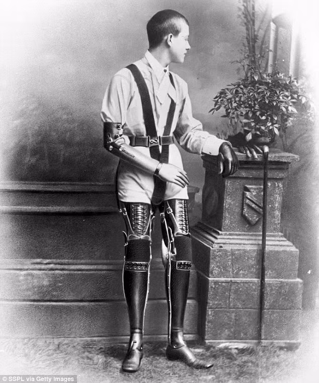 Đến năm 1920, người thợ giày Gillingham đã dùng những đôi chân tay giả này để phục hồi chức năng cho hơn 15.000 bệnh nhân.