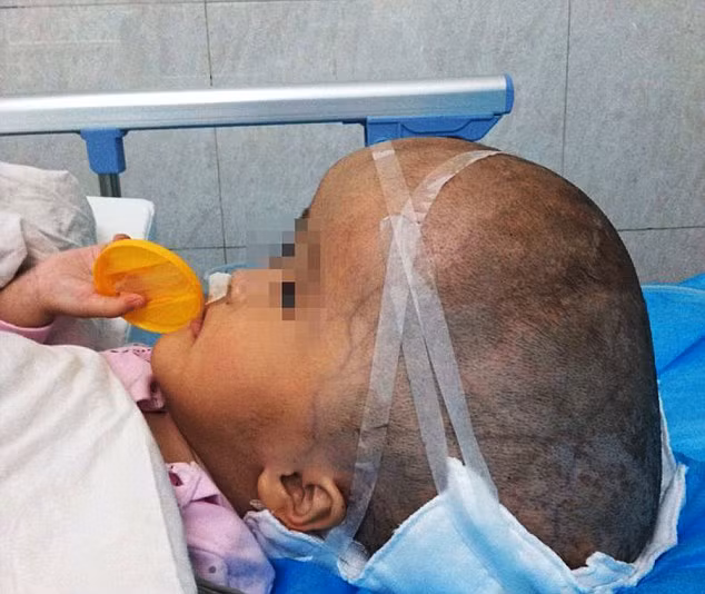 Chu vi vòng đầu của người trưởng thành bình thường là 50cm, trong khi đó của cô bé là 85cm.