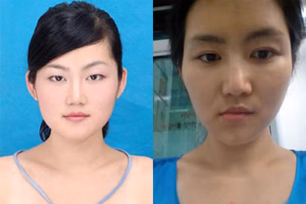 Sau khi sang Hàn Quốc phẫu thuật thẩm mỹ, cô gái Trung Quốc Cận Ngụy Khôn phát hiện chiếc mũi giả của mình bị lệch, hai bên mặt mất cân đối, xương gò má bên rộng bên hẹp, bên cao bên thấp. Hàm dưới vốn là bộ phận Ngụy Khôn ưng ý nhất trên khuôn mặt mình cũng bị bác sĩ chỉnh sửa cho xiêu vẹo.