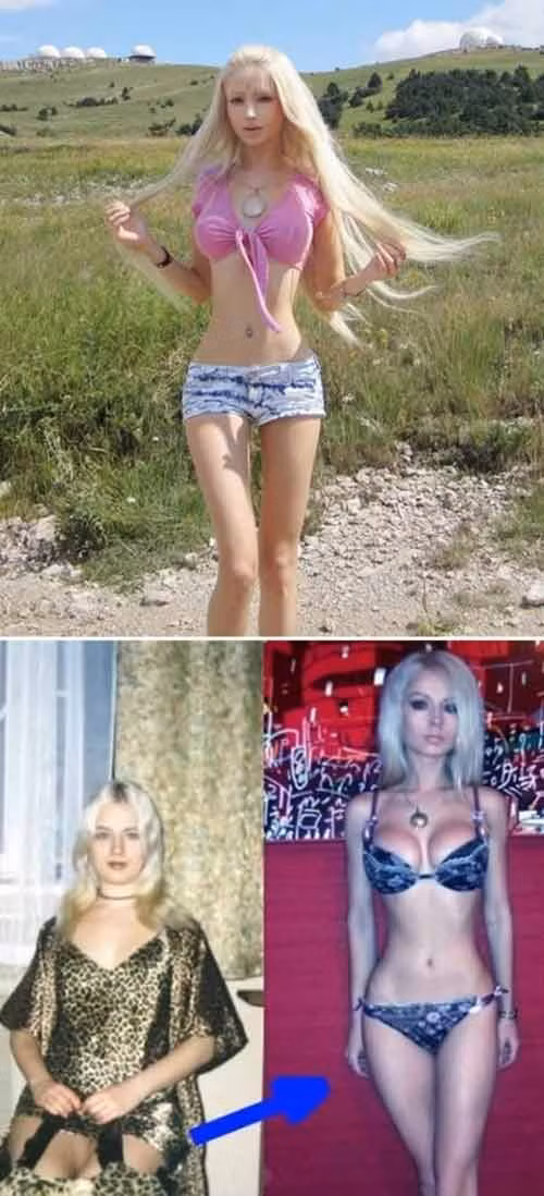 Vòng eo siêu bé kì dị vì cắt xương sườn. Búp bê sống Valeria Lukyanova từng thực hiện hàng loạt ca phẫu thuật nguy hiểm để có ngoại hình giống như cô nàng búp bê barbie. Trong số đó, ca phẫu thuật gây sốc nhất phải kể tới việc cắt xương sườn để tạo vòng eo bé 38 cm.