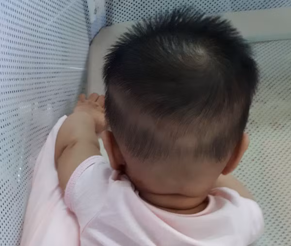 Thay đổi vùng da, màng nhầy. Trẻ thiếu kẽm dễ tái phát tình trạng loét vùng miệng lưỡi, viêm da, mụn bọc, mụn mủ, rụng tóc... Nó cũng khiến trẻ dễ bị viêm đường tiêu hóa, tiêu chảy kéo dài.