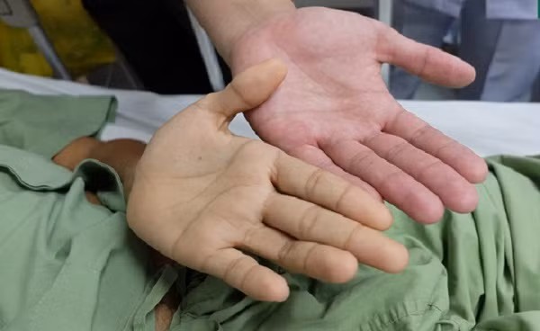 Ngoài hiện tượng da chuyển vàng, người bị bệnh gan còn có biểu hiện niêm mạc, nước tiểu và phân có màu bất thường.
