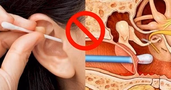 Thực tế, ráy có vai trò bảo vệ ống tai, ngăn côn trùng thâm nhập. Dùng vật nhọn ngoáy tai sẽ làm tổn thương ống tai, gây nấm. Từ đó, bạn có thể đối diện nguy cơ viêm tai giữa nguy hiểm.