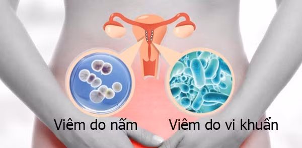 Nguyên nhân bởi có nhiều vi khuẩn trú ngụ trong âm đạo. Sự tồn tại của chúng giúp ổn định môi trường âm đạo, giúp âm đạo thực hiện chức năng tự thanh lọc. Thụt rửa âm đạo nhiều lần sẽ phá vỡ cân bằng vi khuẩn trong âm đạo, gây bất lợi cho sức khỏe vùng kín. Ảnh: Internet