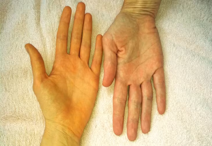 Dấu hiệu cảnh báo gan suy yếu, cần đi khám ngay - Hình 2 Dau hieu canh bao gan suy yeu, can di kham ngay-Hinh-2