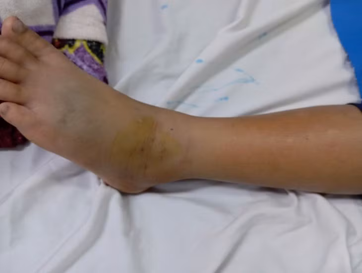 Gia tăng trẻ nhập viện do rắn cắn trong mùa mưa Gia tang tre nhap vien do ran can trong mua mua