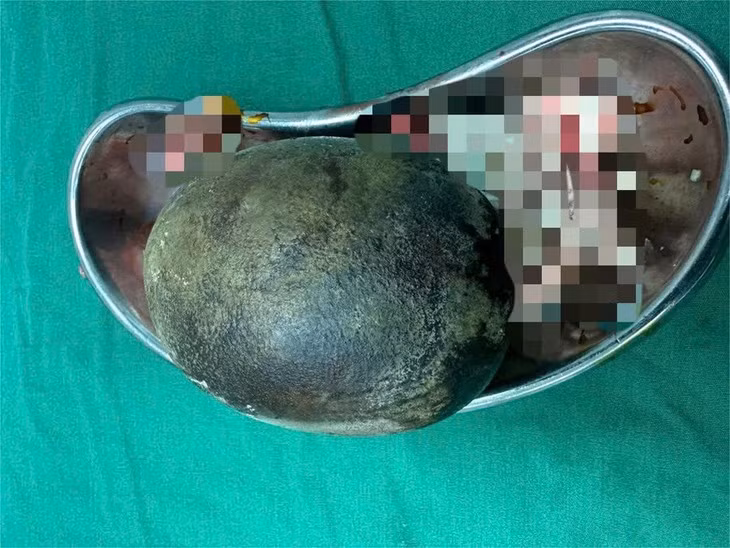 Lay vien soi nang 700g trong bang quang nguoi dan ong 45 tuoi
