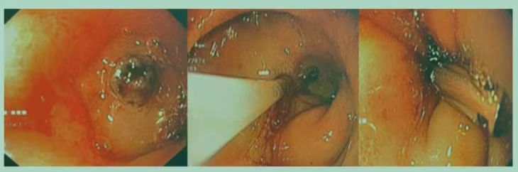 Be trai 13 tuoi oi ra mau vi nhiem khuan Helicobacter pylori