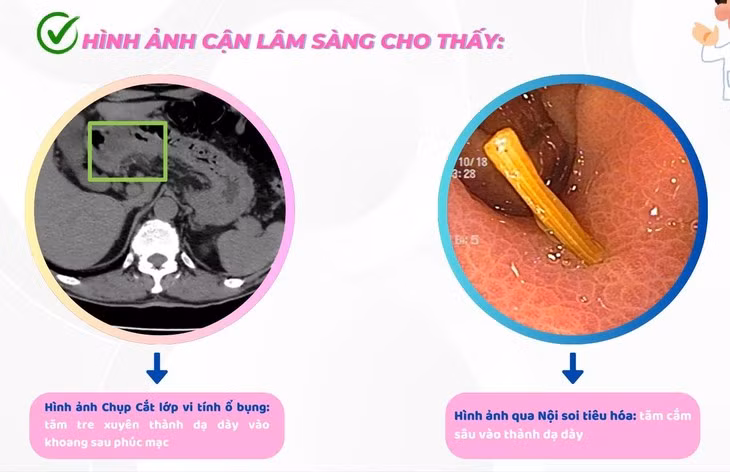 Nhieu truong hop nuot phai tam tre nguy hiem
