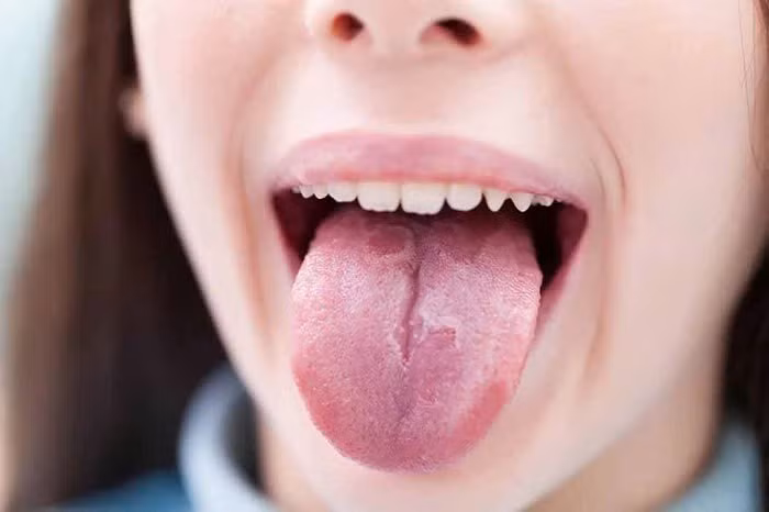 Dấu hiệu khác lạ ở lưỡi cảnh báo những bệnh nguy hiểm - Hình 2 Dau hieu khac la o luoi canh bao nhung benh nguy hiem-Hinh-2