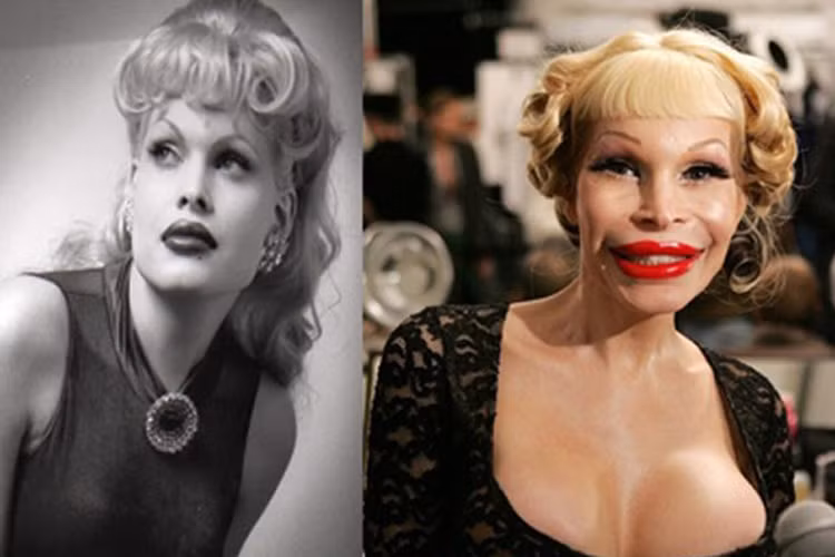 Người mẫu chuyển giới Amanda Lepore làm mũi lần đầu tiên năm 15 tuổi. Từ đó cô liên tiếp bị nghiện phẫu thuật thẩm mỹ. Giờ đây cô khiến gương mặt và thân hình mình trở nên méo mó. 