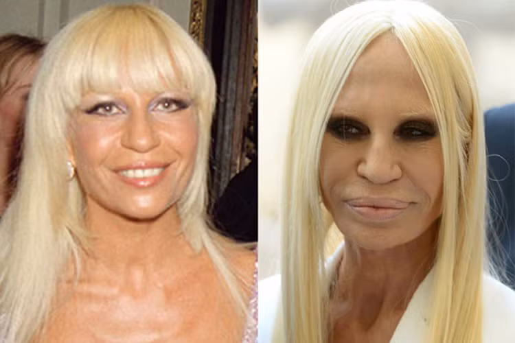 Phó tổng giám đốc tập đoàn danh tiếng Versace, Donatella Versace bị hẹp phần cánh mũi khiến gương mặt mất tự nhiên. Cộng với hậu quả của những cuộc trùng tu nhan sắc khác như bơm môi, căng da mặt, tiêm chất độn, tiêm botox khiến nhà thiết kế thời trang này bị biến dạng gương mặt.