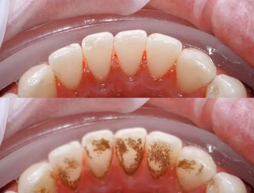 Cao răng là mảng bám đã vôi hóa bởi hợp chất muối Calcium phosphate có trong nước bọt.