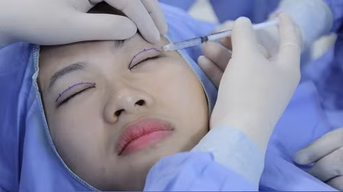 Đầu tiên, bác sĩ định hình vùng mí cần xử lý, sát khuẩn vùng mặt, đặc biệt là vùng mắt. Sau đó tiến hành gây tê vùng mí mắt. Thực tế của việc phẫu thuật mí mắt là tạo ra một nếp gấp nữa trên mí. Ảnh: catmimat