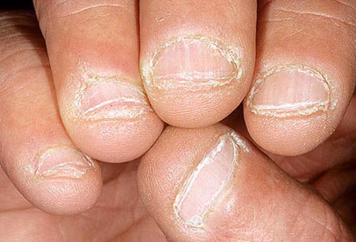 Bong tróc móng tay. Cơ thể thiếu vitamin E sẽ gây ra hiện tượng gãy móng tay hoặc bong tróc móng tay. Nên bổ sung củ cải, rau cải xanh, bơ, hạt dẻ, đu đủ, khoai môn, ớt chuông đỏ... để tăng cường vitamin E cho cơ thể.