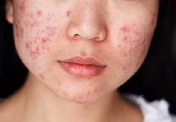Khi bị mụn trứng cá, bạn không nên dùng tay nặn để lấy nhân mụn vì việc này có thể khiến vi khuẩn đi sâu vào bên trong, gây ra nhiễm trùng và mưng mủ. (Nguồn Egynews)