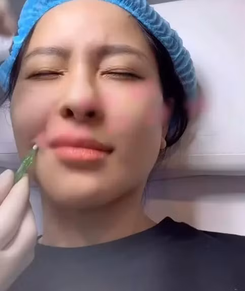 Mới đây, hot girl Trâm Anh chia sẻ loạt ảnh trong thẩm mỹ viện. Theo đó, cô đi trùng tu lại khuôn mặt bằng phương pháp tiêm mặt để xóa rãnh cười.