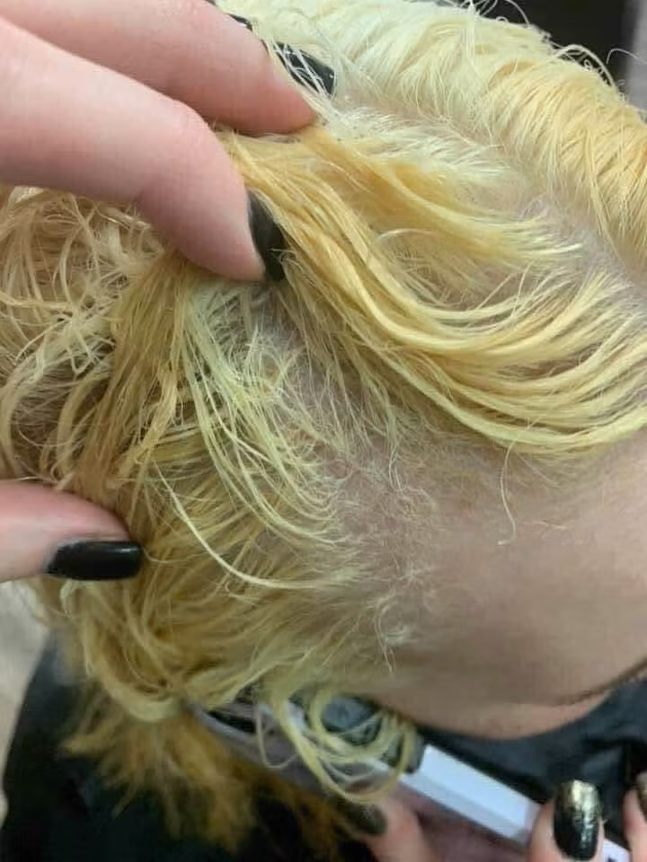 Tình trạng mái tóc sau khi tẩy tệ đến nỗi nhiều phần da đầu lộ ra bởi tóc đã rụng quá nhiều. Mái tóc thì chuyển thành màu vàng trắng trong khi các ngọn tóc vón cục, gãy rụng trông vô cùng kinh dị.