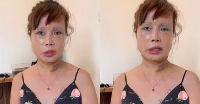 Về phần mình, Thu Sao có vẻ hài lòng với kết quả phẫu thuật nên mới thường xuyên livestream giao lưu với cộng đồng mạng như vậy.