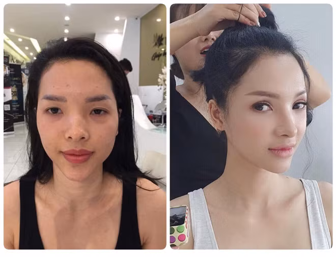 Tại thời điểm đó, chồng chị Hạnh không tin và cũng không muốn vợ đi phẫu thuật vì lo sợ di chứng. Bà mẹ bỉm sữa đã phải thuyết phục chồng rất nhiều, thậm chí dẫn anh tới gặp chị Ngô Thuỳ Linh - người truyền khao khát tân trang nhan sắc cho chị Hạnh, anh mới gật đầu đồng ý.