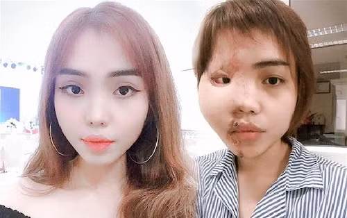 Cách đây 1 năm, vụ việc cô gái tên Lan Vy bị chính chồng mình tạt thẳng axit vào mặt vì ghen tuông vô lối khiến cộng đồng mạng bức xúc.