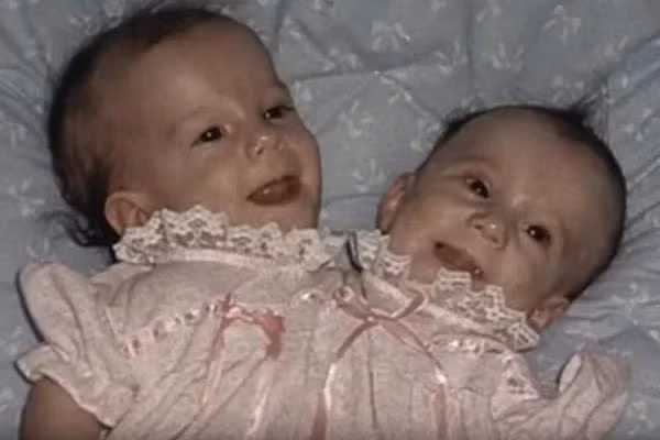 Vào khoảng thời gian cả 2 mới chào đời, các bác sĩ thông báo cho cha mẹ của cặp đôi rằng khả năng sống sót của hai chị em là không nhiều khi cứ 30 triệu cặp song sinh dính liền thì chỉ có một cặp sống sót.