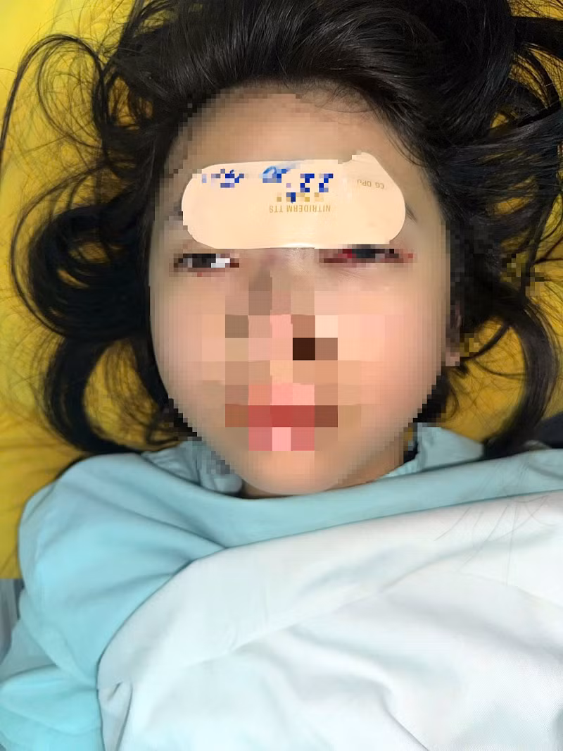Bác sĩ "giật mình" vì nữ sinh 14 tuổi tự tiêm filler nâng mũi Bac si