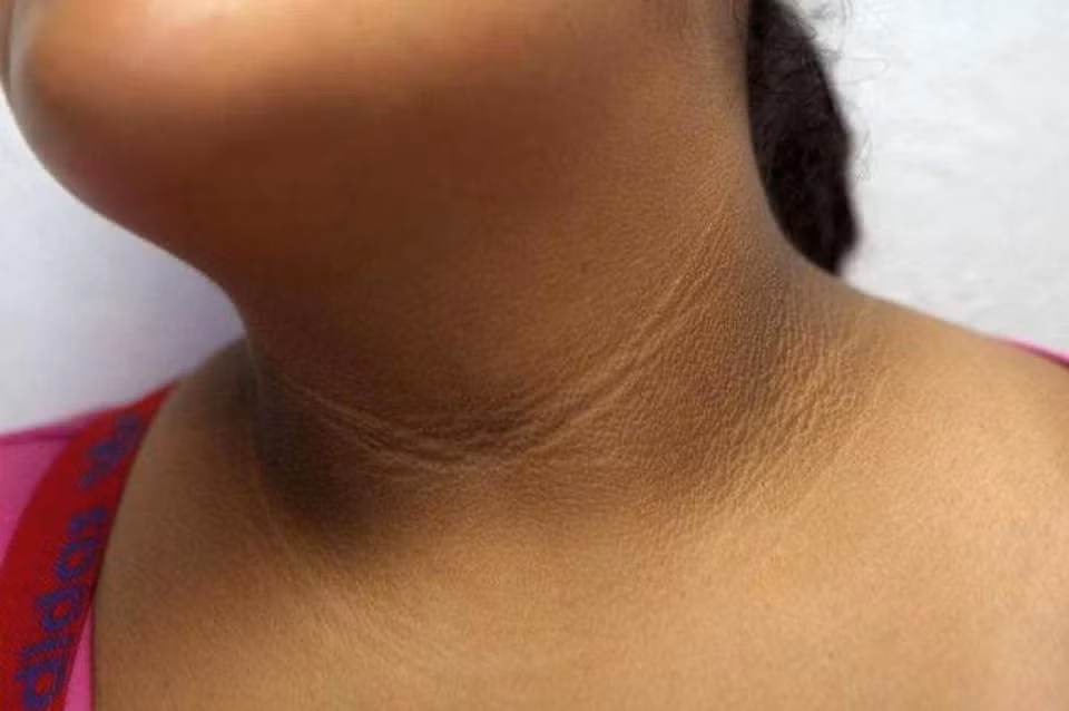  Bệnh gai đen: Bệnh gai đen là tình trạng các mảng da sẫm màu như nhung xuất hiện ở cổ, bẹn hoặc dưới cánh tay. Bệnh này phổ biến hơn ở những người có làn da sẫm màu. Bệnh gai đen xảy ra ở người mắc PCOS do chỉ số BMI tăng và mức insulin không đều. Ảnh: NHS. *Tiêu đề bài viết do BTV đặt lại!