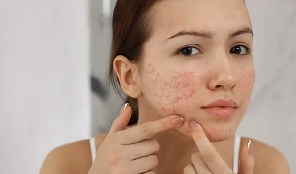  Da mụn hoặc da dầu: Một trong những triệu chứng khó chịu nhất mà phụ nữ mắc PCOS phàn nàn là mụn trứng cá và mụn nhọt, theo NDTV. Đây là một trong nhiều biểu hiện về da liễu của tình trạng hormone nam cao. Trong PCOS, nồng độ testosterone cao khiến lượng và hoạt động của tuyến dầu và mồ hôi cao hơn, dẫn đến dầu làm tắc nghẽn lỗ chân lông, gây ra mụn trứng cá. Chúng thường xuất hiện trên mặt, cổ, lưng. Ảnh: Asraderm.
