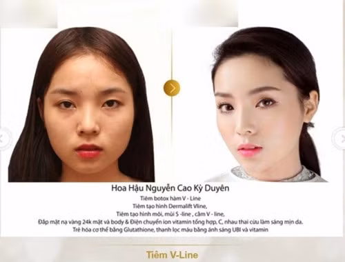 Dẫu vậy, bằng chứng lại lộ ra khi một thẩm mỹ viện tung bức ảnh Kỳ Duyên trước và sau khi sử dụng các dịch vụ làm đẹp tại đây. Trước những bằng chứng này, Kỳ Duyên không có phản hồi nào. Gần đây cô nàng còn đi cải thiện vòng 1.