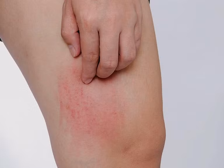 Biểu hiện 2: Trên da nổi mụn. Thực chất không chỉ vùng kín của nam giới mà ở các bộ phận khác, rận mu cũng có thể gây ra hiện tượng này. Cần biết rằng, rận mu xuất hiện ở bộ phận nào thì sẽ bộ phận đó sẽ nổi một vài nốt mẩn đỏ nhỏ, thậm chí bị nổi vảy máu, bị dị ứng và có hiện tượng nổi mụn trên da.