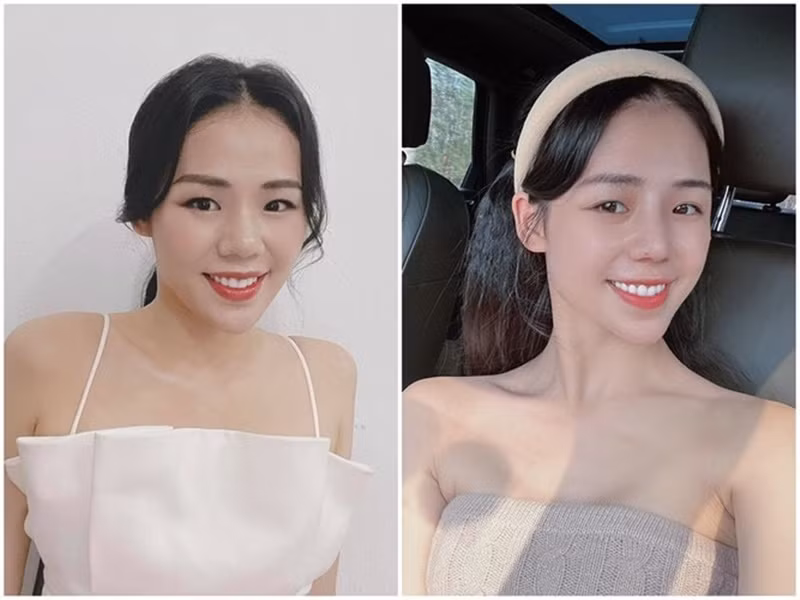 Năm 2023, nữ ca sĩ Hương Ly sửa mũi, nâng ngực để nhan sắc hoàn thiện hơn.