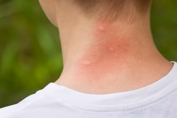 Đáng lưu ý, muỗi đốt sẽ khiến da bị ngứa, lây truyền nhiều bệnh như sốt rét, sốt xuất huyết, giun chỉ, sốt vàng da,... Để tốt cho sức khỏe, ngăn ngừa muỗi đốt rất quan trọng.