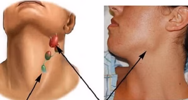 Khi đi vào cơ thể, nó gây kích ứng niêm mạc đường hô hấp, mắt; gây ra các triệu chứng như ho, hen suyễn, hắt hơi, đau họng, thậm chí gây ung thư vòm họng. Năm 2004, Cơ quan Nghiên cứu Ung thư Quốc tế phân loại formaldehyde là một trong những chất gây ung thư.