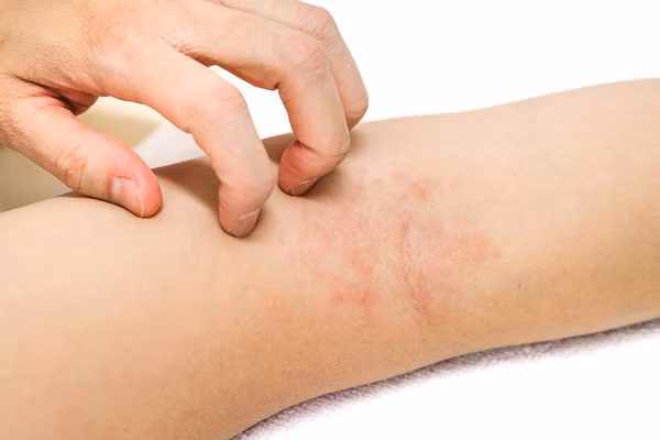 Khi gan bị tổn thương, chất độc chuyển hóa sẽ không được thải trừ, tích tụ lại trong cơ thể. Các chất này tích tụ dưới da sẽ gây phản ứng viêm gây ngứa. Ngứa do tổn thương gan thường có các biểu hiện như nổi mẩn như phát ban. Vị trí ngứa có thể ở cổ, tay hoặc toàn thân; nổi sẩn rải rác hoặc tập trung thành đám.