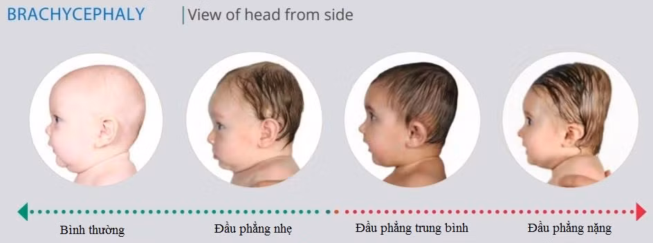 Hầu hết trường hợp hội chứng đầu phẳng không gây vấn đề sức khỏe nghiêm trọng vì không ảnh hưởng tới não. Tuy vậy, trường hợp đầu phẳng mức độ trung bình, nặng có thể gây một số vấn đề sức khoẻ như loạn thị, chậm phát triển, khó ăn, khó học tập, khó nói, mất tầm nhìn, nguy cơ nghe kém, rối loạn chức năng khớp hàm dưới, động kinh, vẹo cột sống,...