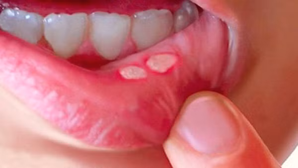 Trái lại, những người nóng trong, táo bón, loét miệng nên tận dụng vỏ gừng để pha trà uống. Tuy nhiên, bạn cần phải chú ý đến liều lượng, không nên uống quá nhiều, liên tục tránh gây tổn thương dạ dày.