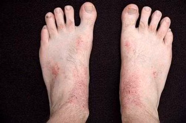 Bệnh ngoài da. Bệnh ngoài da như mụn cơm, nấm da chân rất dễ lây lan. Nếu vợ hoặc chồng mắc, người kia cần chú ý ngừa bệnh. Nguyên nhân bởi vi khuẩn, virus gây bệnh có thể bám trên bề mặt các vật dụng trong nhà như dép, chậu rửa, chăn gối... Không vệ sinh sạch sẽ, những mầm bệnh này có cơ hội lây lan, gây bệnh cho người tiếp xúc. (Ảnh minh họa)