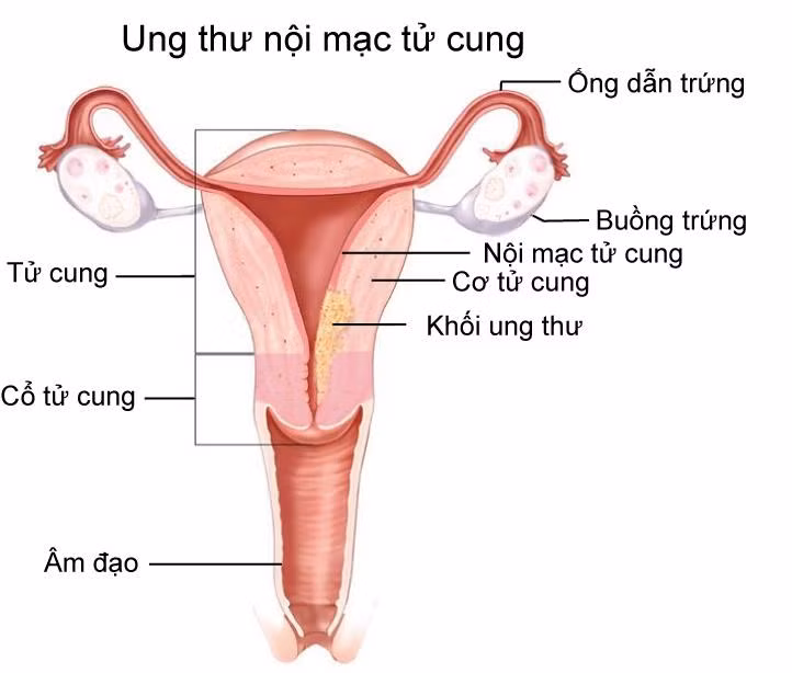 Phân biệt lạc nội mạc tử cung với đau bụng kinh Phan biet lac noi mac tu cung voi dau bung kinh