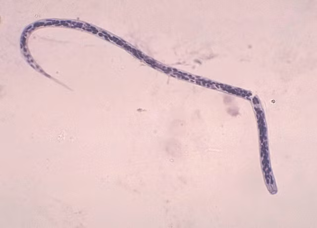 Bệnh giun chỉ Onchocerca volvulus dẫn đến tình trạng viêm nhiễm nghiêm trọng trong mắt, làm tổn thương các cấu trúc quan trọng và thường gây mù vĩnh viễn. Ký sinh trùng này được truyền bởi loài ruồi đen sống gần nơi có nước. Chúng chích vào da và truyền những con giun chưa trưởng thành. Ấu trùng trưởng thành tạo ra hàng ngàn ấu trùng nhỏ gọi là vi giun chỉ, định cư khắp cơ thể. Khi đến mắt, chúng có thể gây viêm, tạo sẹo ở giác mạc và các mô sâu hơn của mắt bao gồm màng mạch và dây thần kinh thị giác.