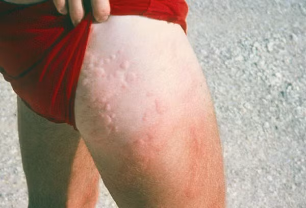  Viêm da do nhiễm khuẩn. Bệnh do vi khuẩn sinh sống trong nước tại các bể bơi (vi khuẩn gram âm, trực khuẩn mủ xanh...) gây ra, biểu hiện bằng các nốt viêm, sưng nề, hóa mủ. Vi khuẩn trong bể bơi cũng có thể dễ dàng xâm nhập cơ thể qua các vết thương nhỏ có sẵn trên da và gây viêm da.
