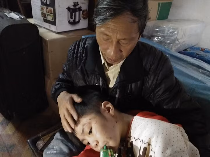 Những vết sẹo vẫn còn in hằn trên mặt của cháu Gia Khánh do bố đẻ, mẹ kế bạo hành.