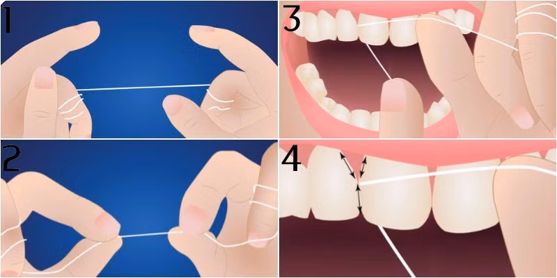 Do đó, bạn nên chọn loại chỉ nhỏ, mềm và mịn để tránh tổn thương men răng. Ảnh: nhakhoathutrang.