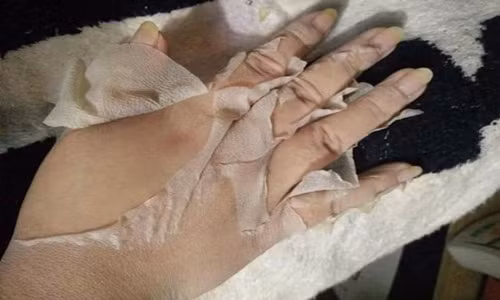 Mặc dù là phương pháp được quảng cáo, tung hô khá nhiều những lột da, thay da làm đẹp tiềm ẩn rất nhiều nguy cơ biến chứng đi kèm. Các loại kem lột da được chào bán hiện nay có rất nhiều loại là sản phẩm trôi nổi, gia công không rõ nguồn gốc, chất lượng. Ảnh: Facebook TSDK.