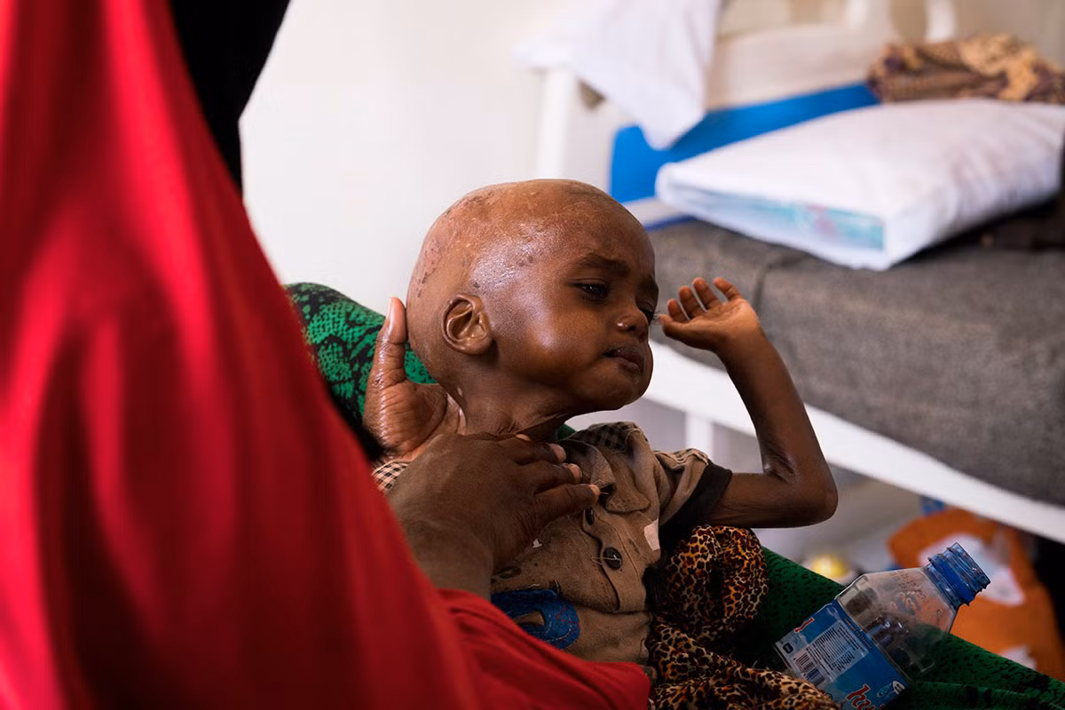 Bé Isse Mohammed được mẹ bế trên tay tại một trung tâm y tế ở Garowe, Puntland. Được biết, Isse đã bị suy dinh dưỡng trầm trọng.