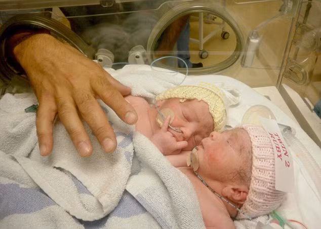 Bé Rosie và Ruby Formosa ra đời năm 2012 dính liền phần ruột.