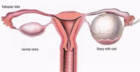 Không chỉ gây rong kinh dài ngày, lạm dụng thuốc tránh thai lùi ngày kinh nguyệt còn có thể gây rối loạn kinh nguyệt, buồng trứng đa nang và các bệnh phụ khoa khác.