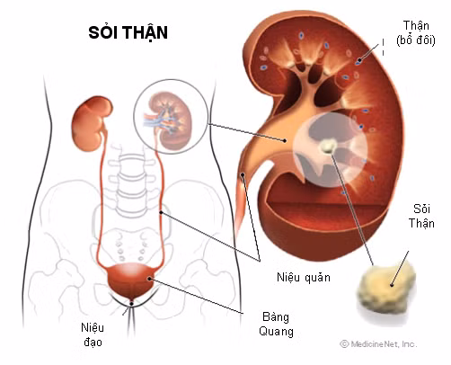 1. Uống đủ nước. Bác sĩ Julio Davalos, Giám đốc Khoa nội tiết niệu và thận tại Đại học Maryland Baltimore (Trung tâm Y khoa Washington, Mỹ) cho hay, thủ phạm lớn nhất của sỏi thận là mất nước. Do đó, uống đủ nước cách đơn giản để ngừa sỏi thận. Mặt khác, khoáng chất trong các thực phẩm chúng ta ăn hàng ngày như canxi, oxylate, phosphate hay axit uric...cơ thể cần phải có đủ nước để hòa tan chúng.